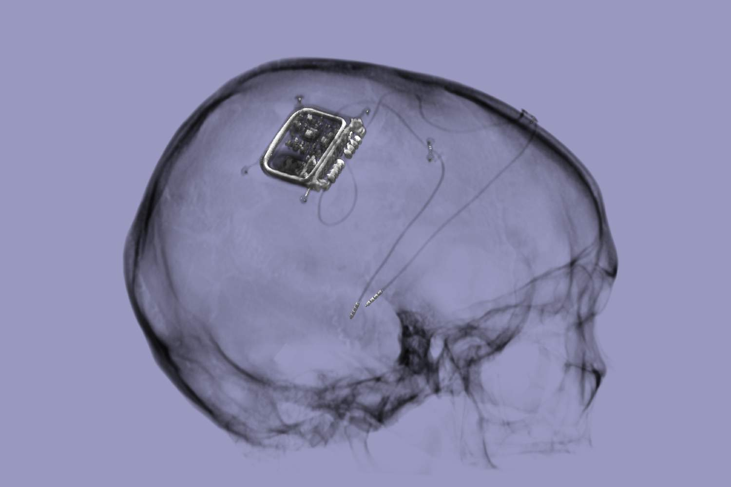 xray showing skull and picostim brain stimulator implant